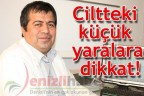 Ciltteki küçük yaralara dikkat!