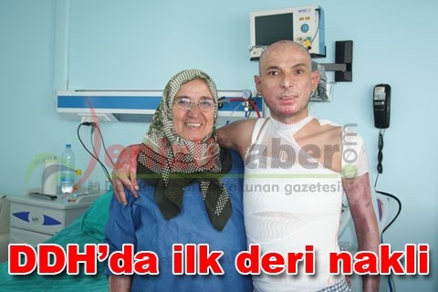 DDH’da ilk deri nakli