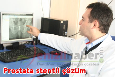 Prostata stentli çözüm