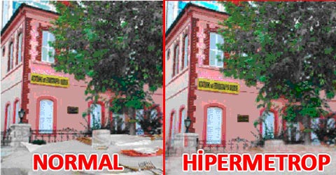 hipermetrop