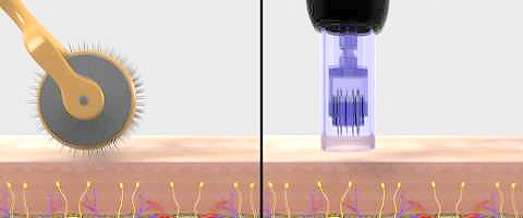 dermapen3-ic