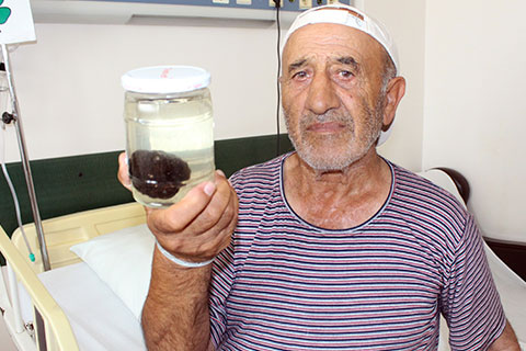 Hastanın mesanesinden 120 gram ağırlığında taş çıkarıldı