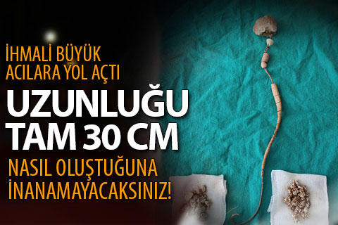 Hastanın böbreği ile mesanesi arasında 30 cm taş çıkarıldı