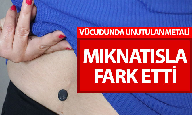 Vücudunda unutulan metali mıknatısla fark etti