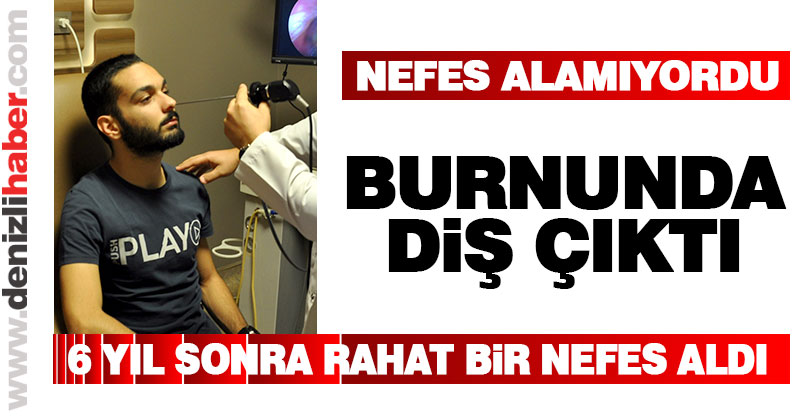 Burnundaki diş 6 yıl sonra çıkartıldı