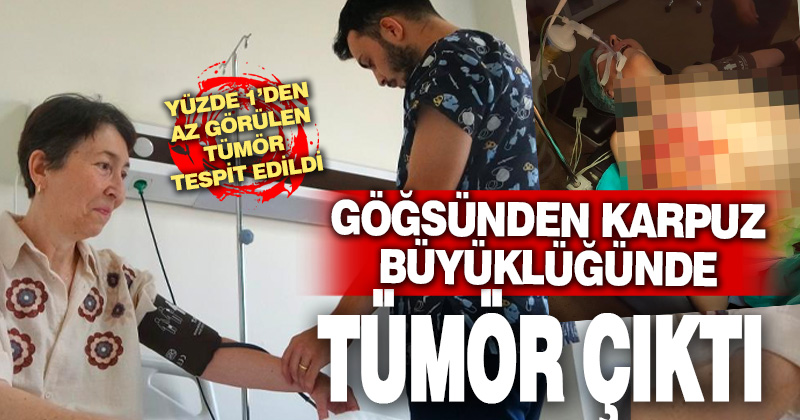 Karpuz büyüklüğündeki tümör göğsünü patlattı