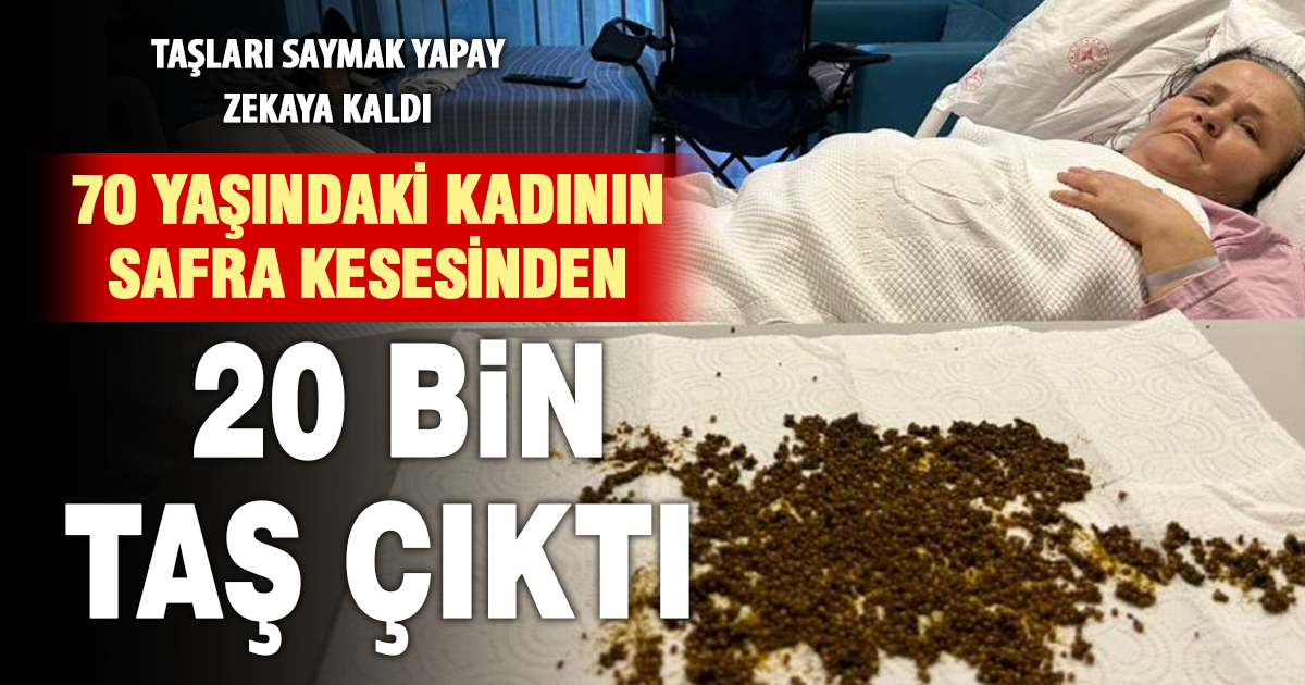 Hastanın safra kesesinden çıkan taş sayısı, sağlık ekibini bile hayrete düşürdü