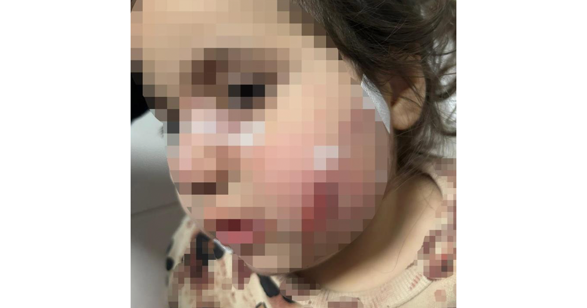 Köpek dehşeti: 3 yaşındaki Ada’nın yüzü pençe ve ısırıkla dolu 